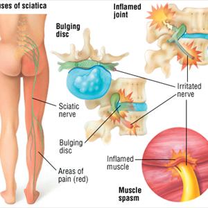 Cortisone Injections For Sciatic Nerve - How Can Magnetic Therapy Relieve Sciatica?