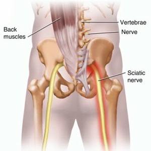 Sciatic Nerve Location - Sciatica ... 3 Things You Must Know
