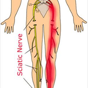Sciatica Treatment For - Chiropractor, Tampa: Low Back Pain And Sciatica.