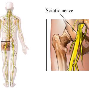 Sciatica Nerve Exercises - Sciatica... The 3 Guarantees