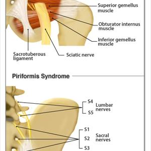 Symptoms Of Sciatic Problems - Pain Relief | Do You Know The Causes Of Sciatica Nerve Pain?