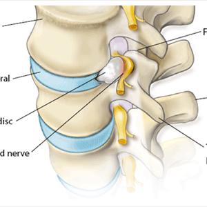 Herniated Disc In Back - Sciatica ... The Incredible Discovery