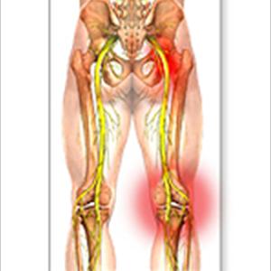 Physical Therapy Exercises For Sciatica - How To Get Exercise Relief For Sciatica