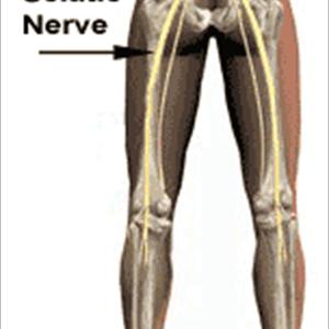 What Is Sciatica Running Exercises - Pinched Nerve Pain Causes And Relief With The Drx9000 Spinal Decompression System